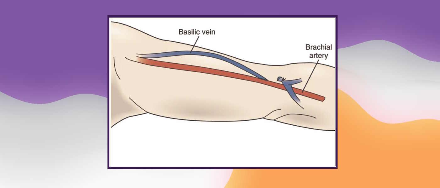 AV Fistula